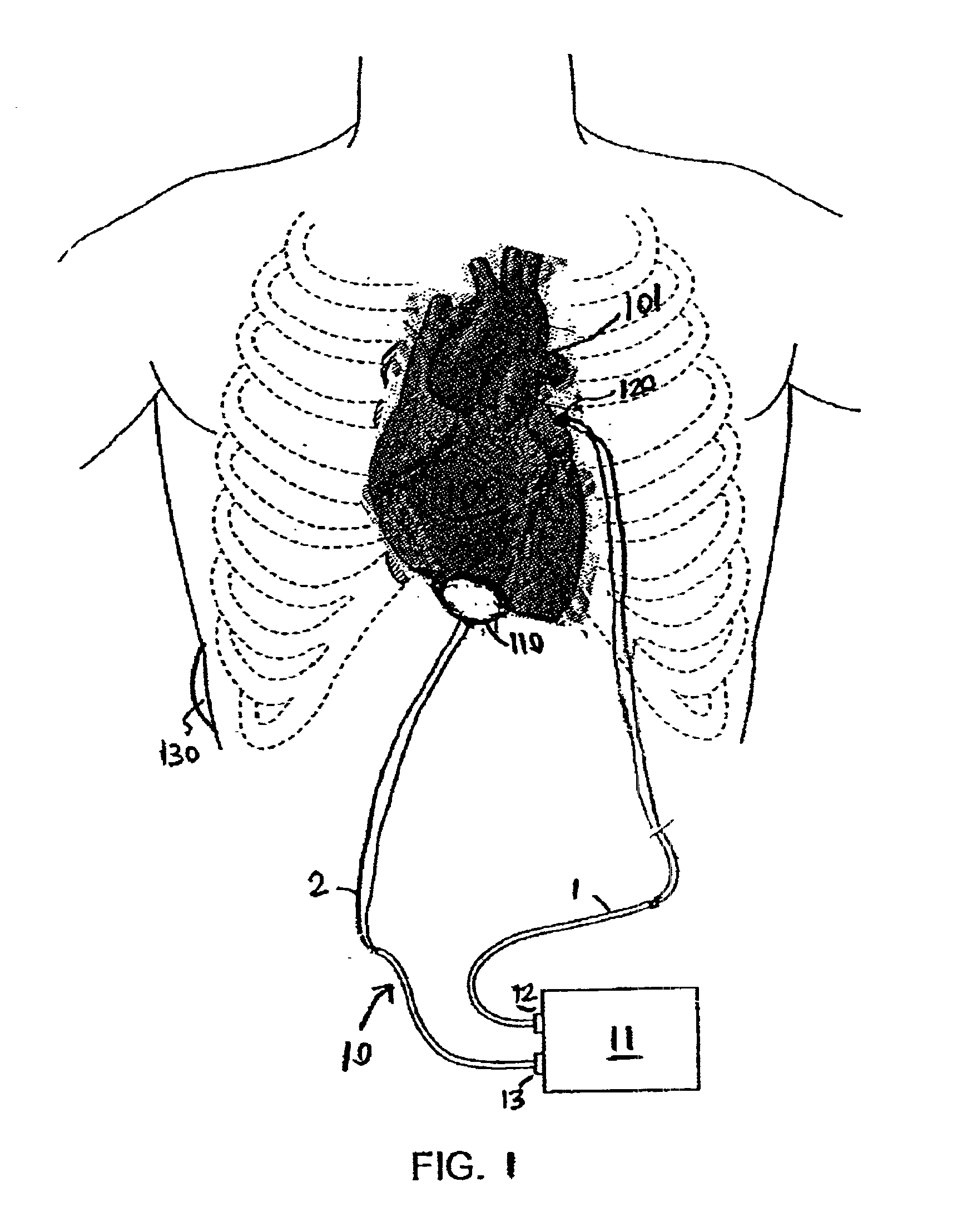 Expandable intracardiac return electrode and method of use