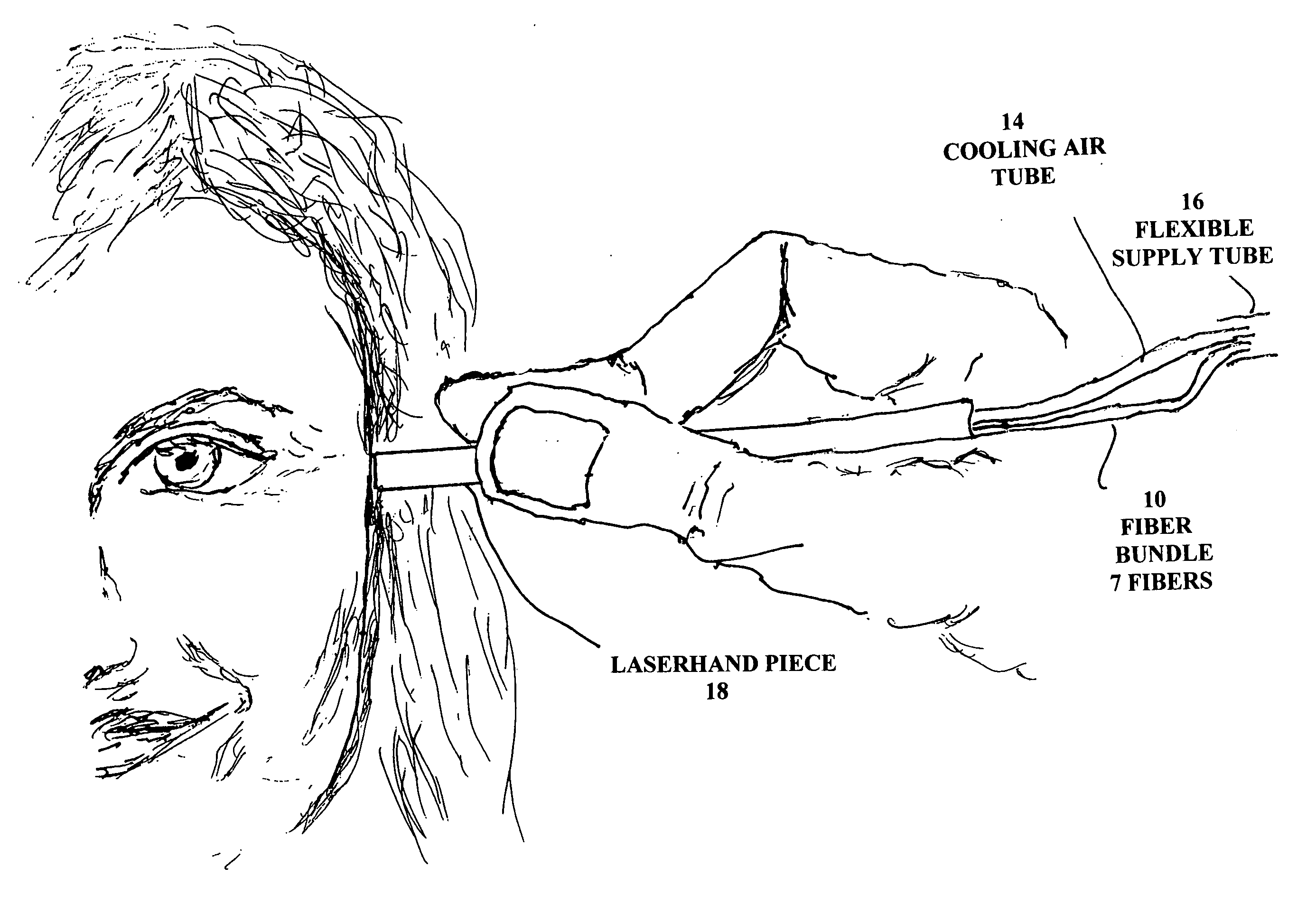 Laser treatment system and method for producing thermal cavities and energy droplets