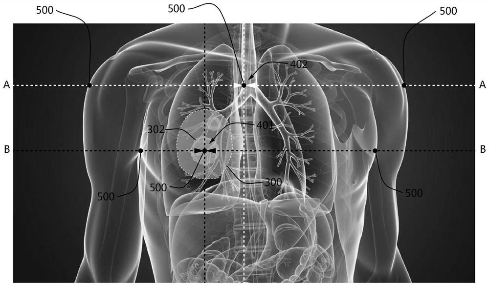 CT positioning method in radiotherapy process