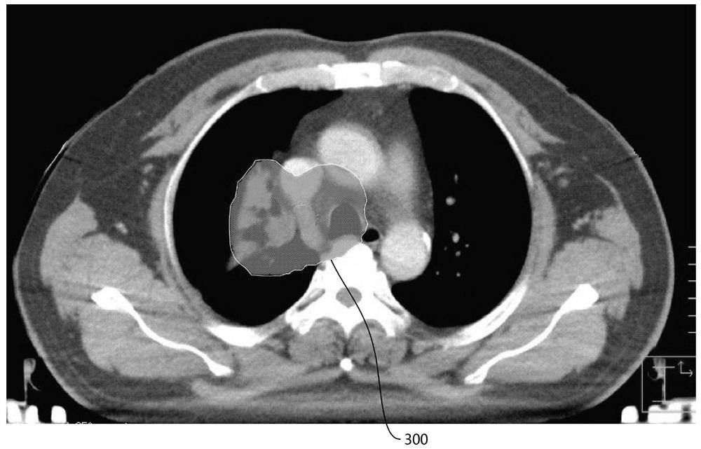 CT positioning method in radiotherapy process