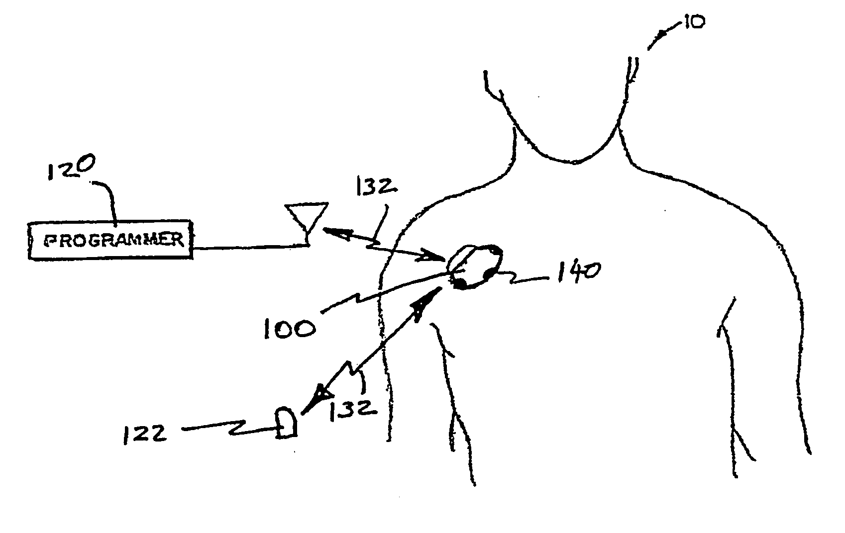 Techniques for data reporting in an implantable medical device