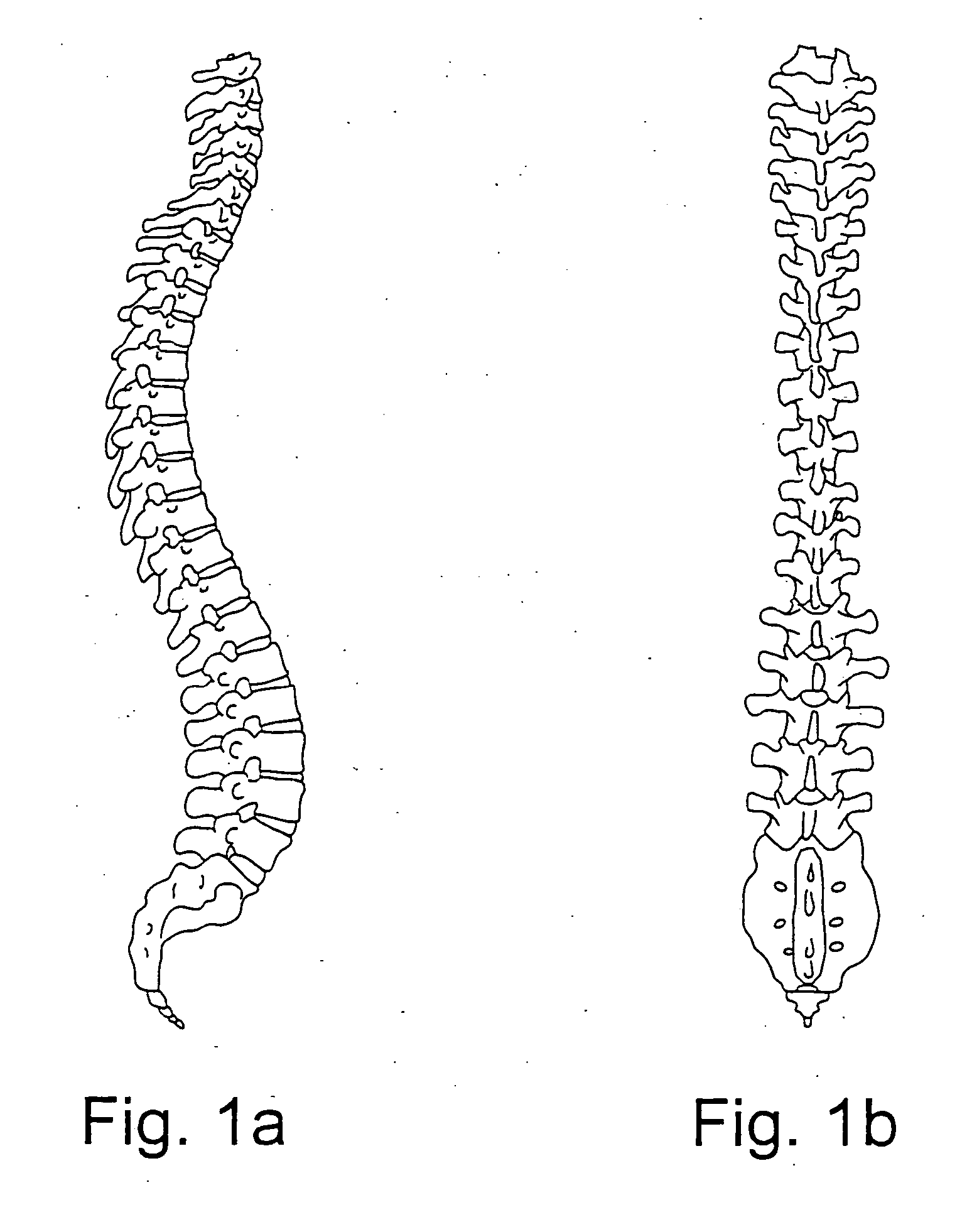 System and methods for improved access to vertebral bodies for kyphoplasty, vertebroplasty, vertebral body biopsy or screw placement