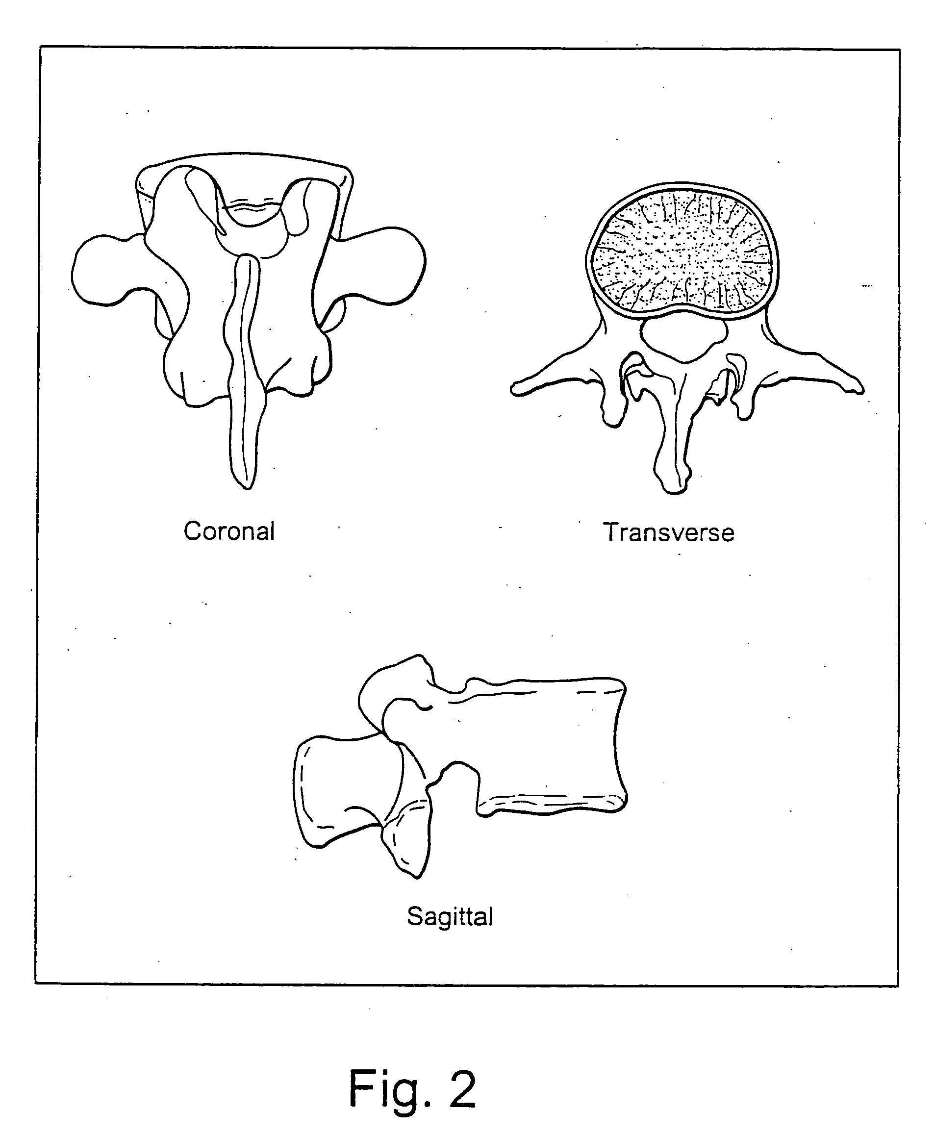 System and methods for improved access to vertebral bodies for kyphoplasty, vertebroplasty, vertebral body biopsy or screw placement