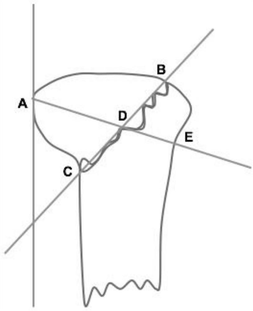 A digital fabrication method of condylar fracture nail retention surgical guide