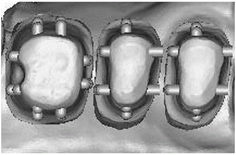 Dental restoration CAD (computer aided design)/metal 3D automatic processing method