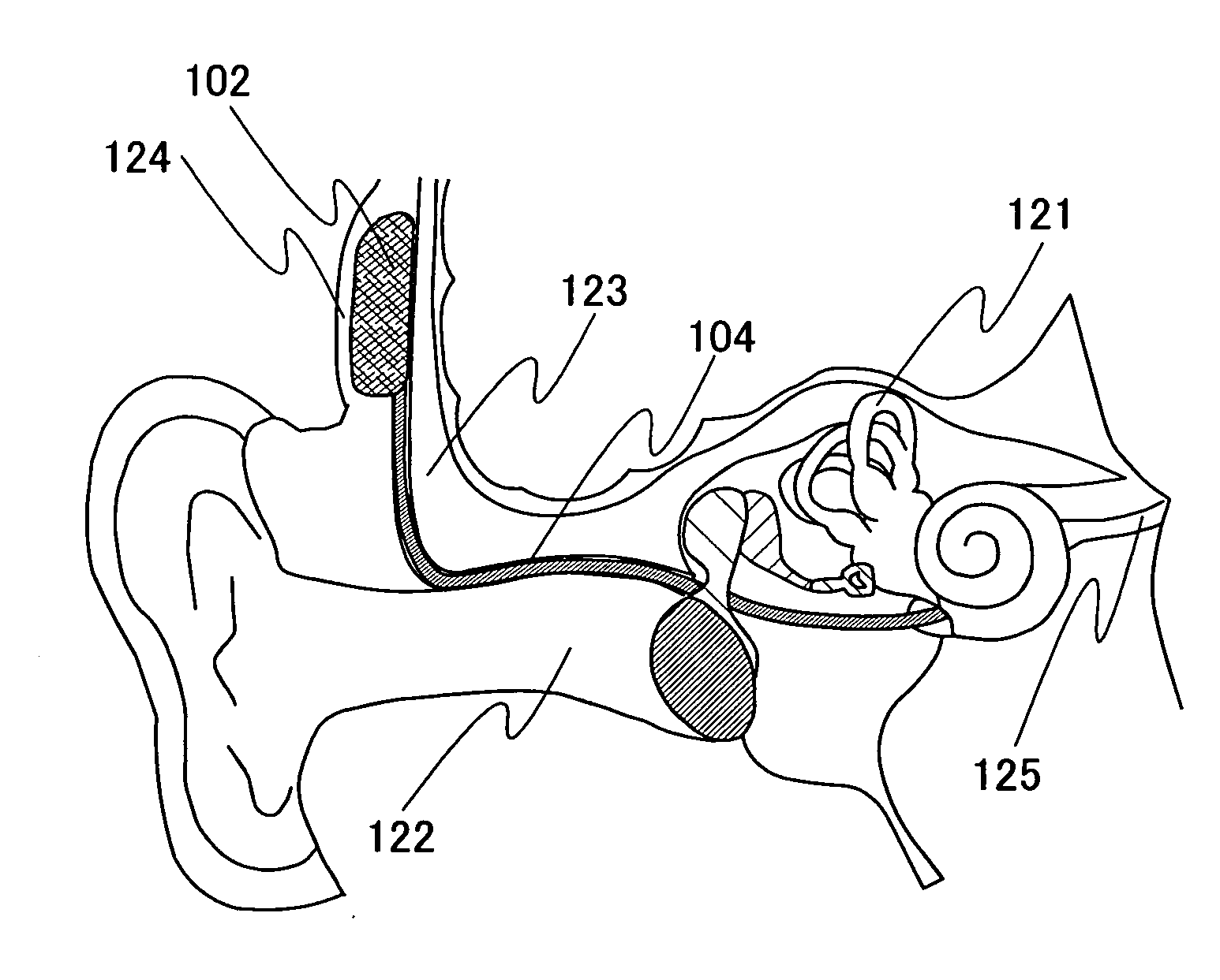 Cochlear implant device, extracorporeal sound collector, and cochlear implant system having the same