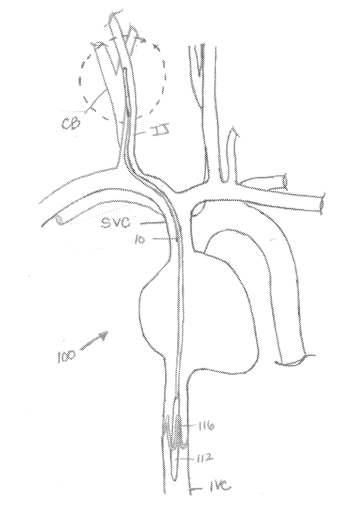 Intravascular system and method for blood pressure control