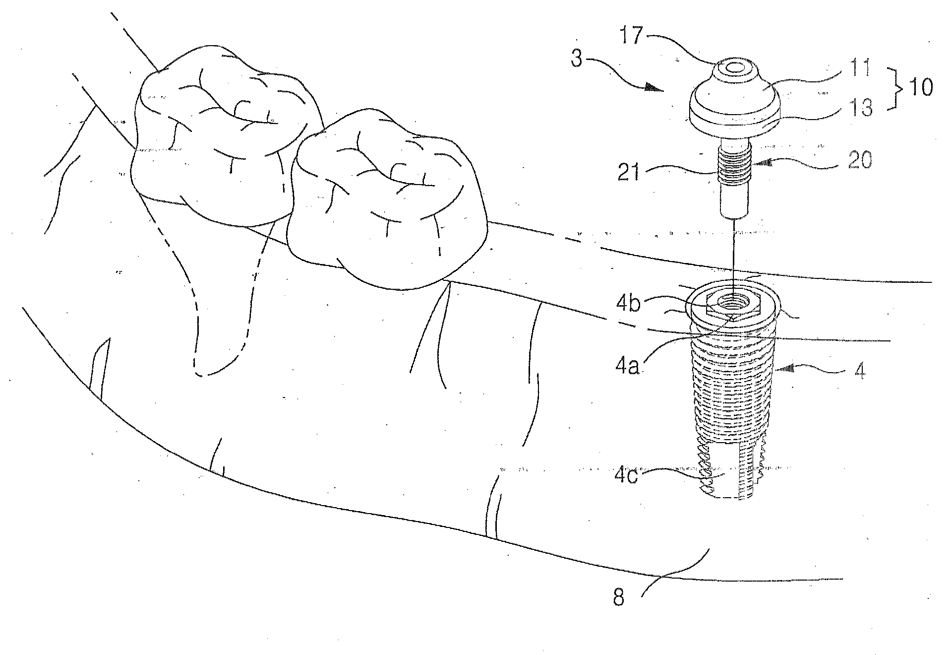 Healing Abutment and Dental Implant Having the Same