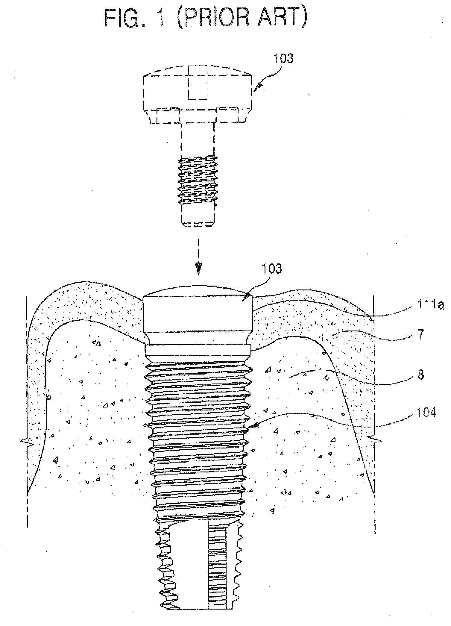 Healing Abutment and Dental Implant Having the Same