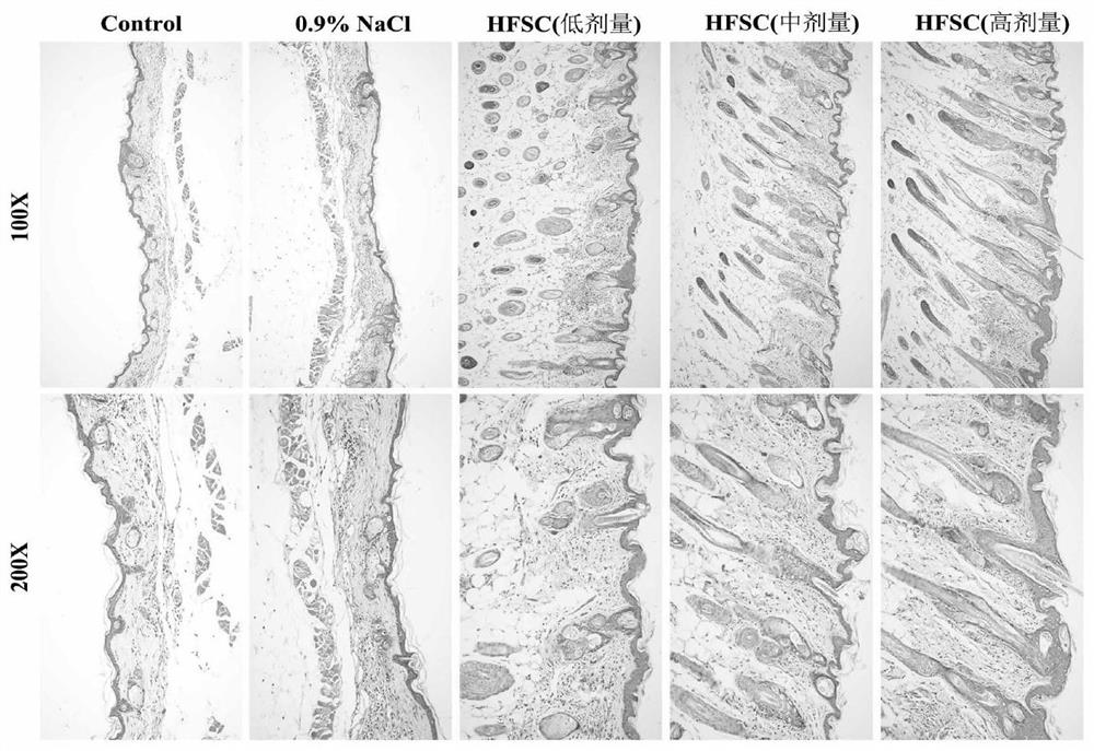 Hair follicle microarray co-culture system and application in medicine for treating pathological alopecia