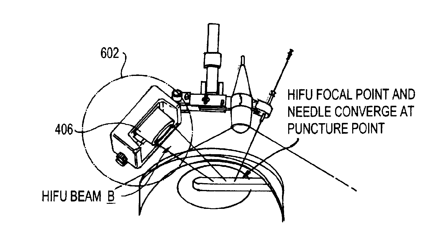 Robotic localizing aid for high-intensity focused ultrasound delivery