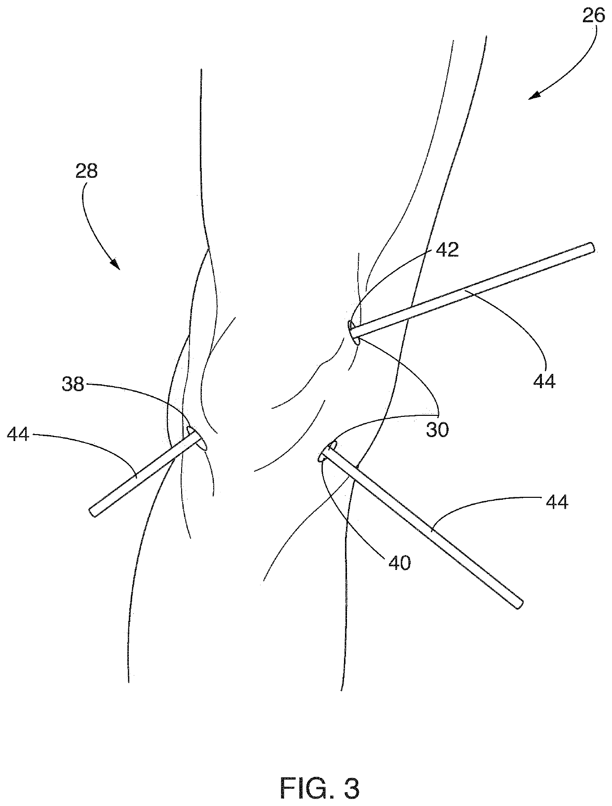 Systems and methods for reducing contaminants in a portion of a patient