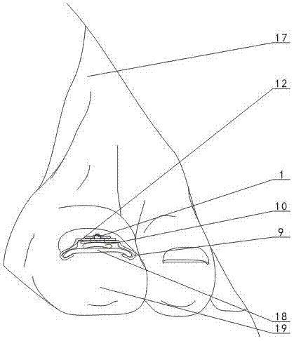 Ingrown nail both-side correction device