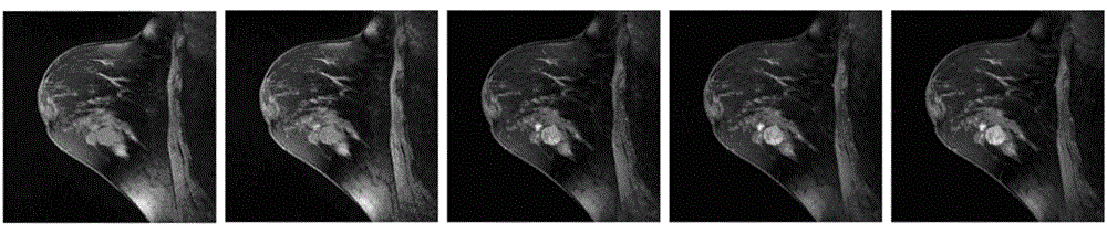 A registration method for dynamic contrast-enhanced magnetic resonance image sequences of the breast