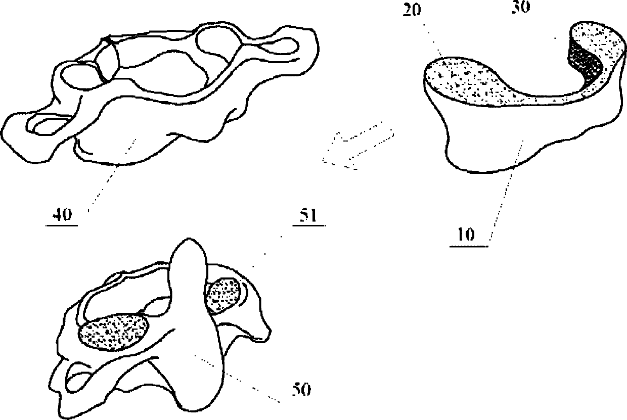 Atlas fusion prosthesis