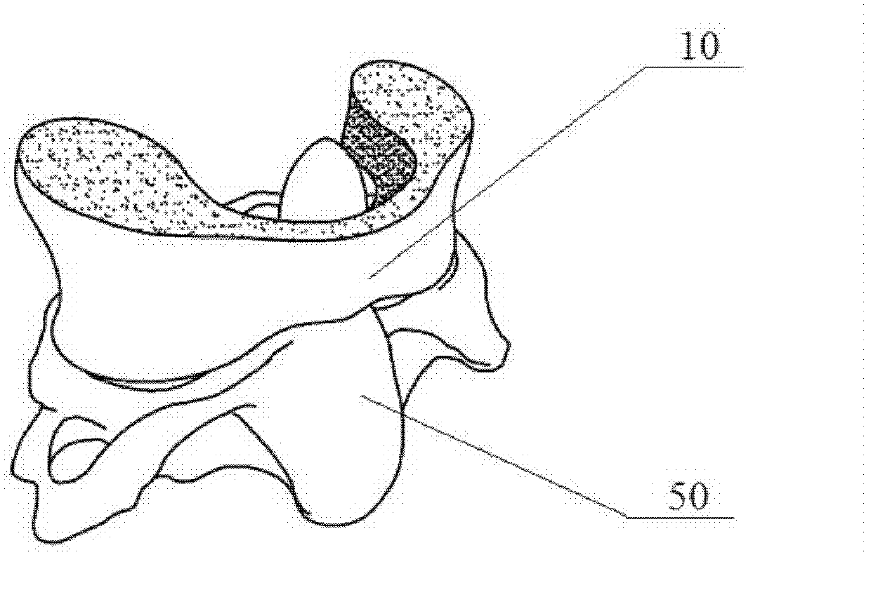 Atlas fusion prosthesis