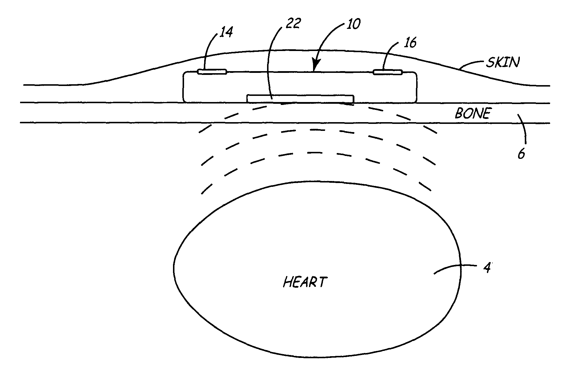 Method and apparatus for monitoring heart function in a subcutaneously implanted device