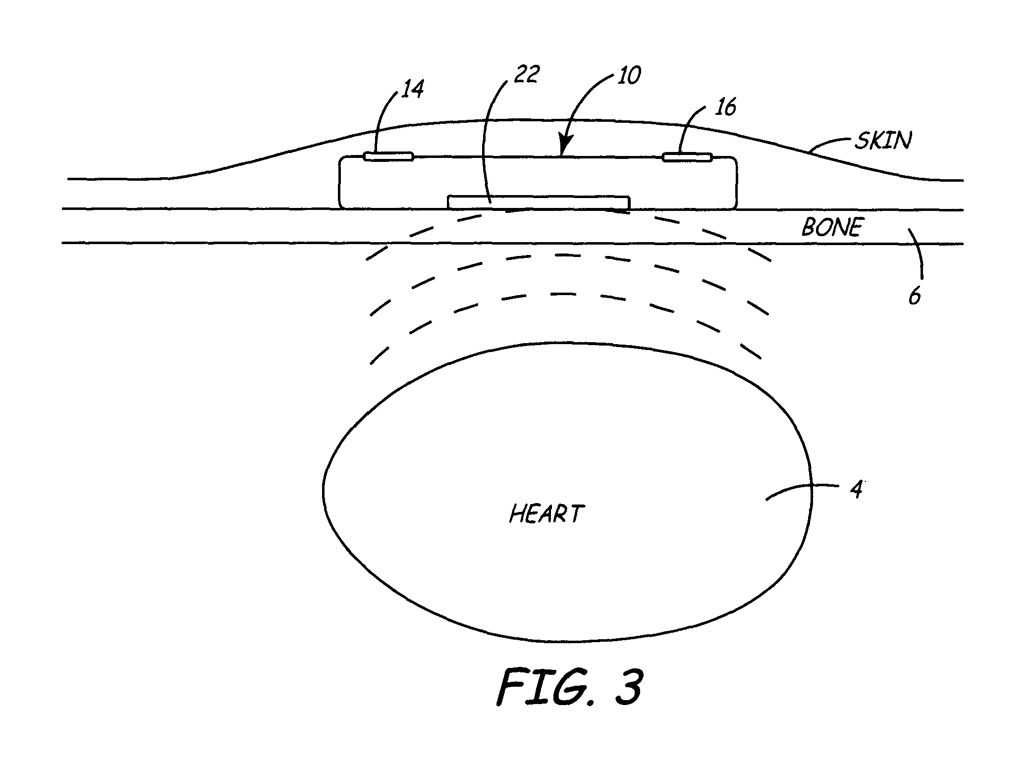 Method and apparatus for monitoring heart function in a subcutaneously implanted device