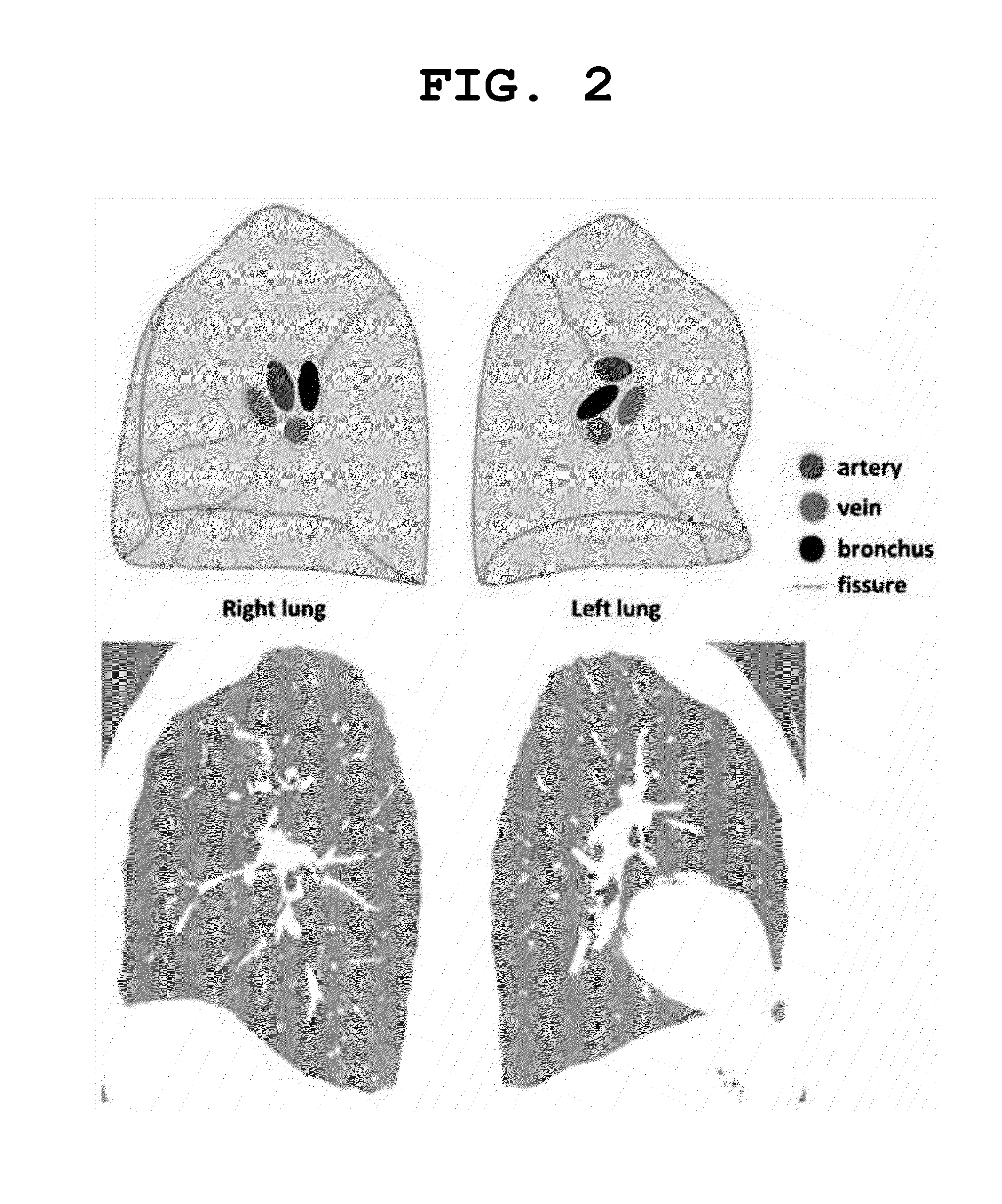 Method for distinguishing pulmonary artery and pulmonary vein, and method for quantifying blood vessels using same