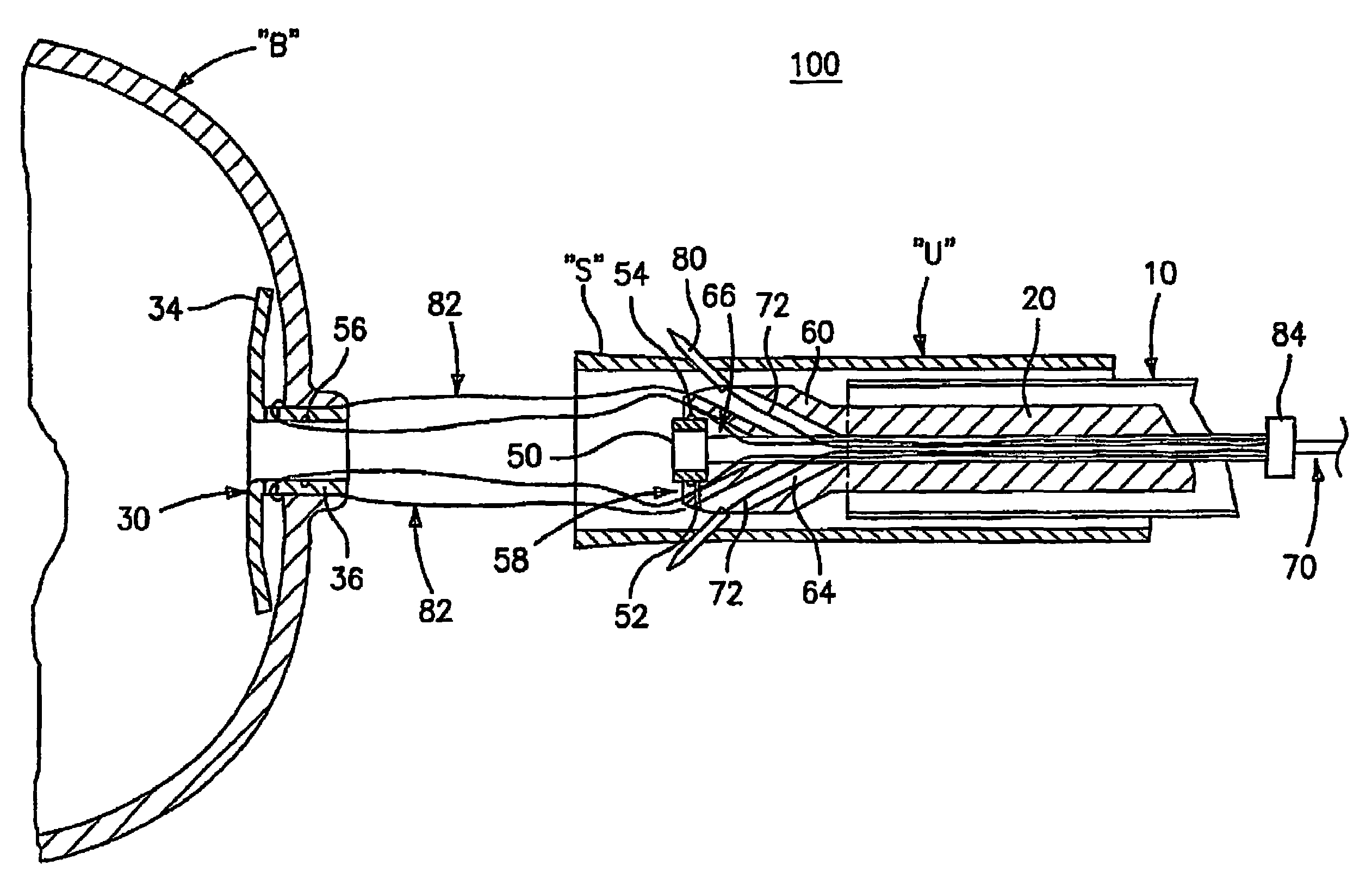 Method and apparatus for radical prostatectomy anastomosis including an anchor for engaging a body vessel and deployable sutures