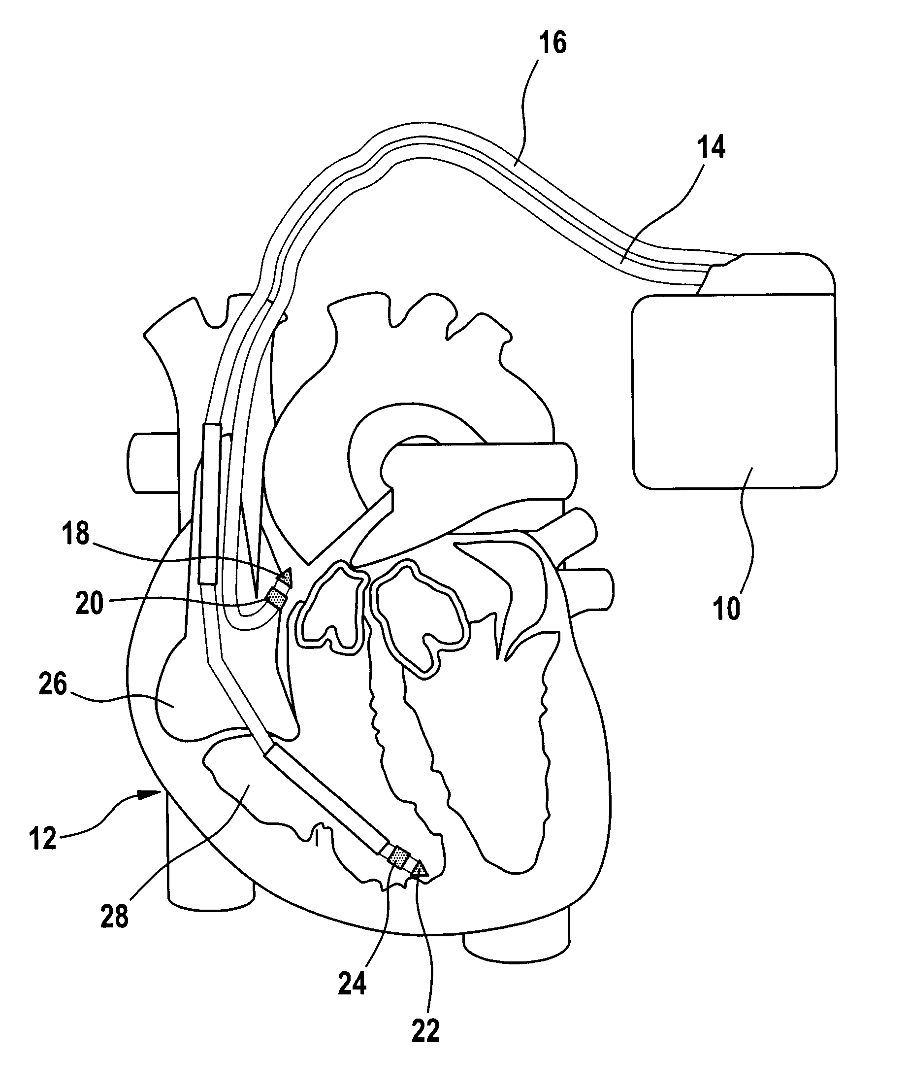 Heart stimulator with override for stimulation exceeding a maximum rate