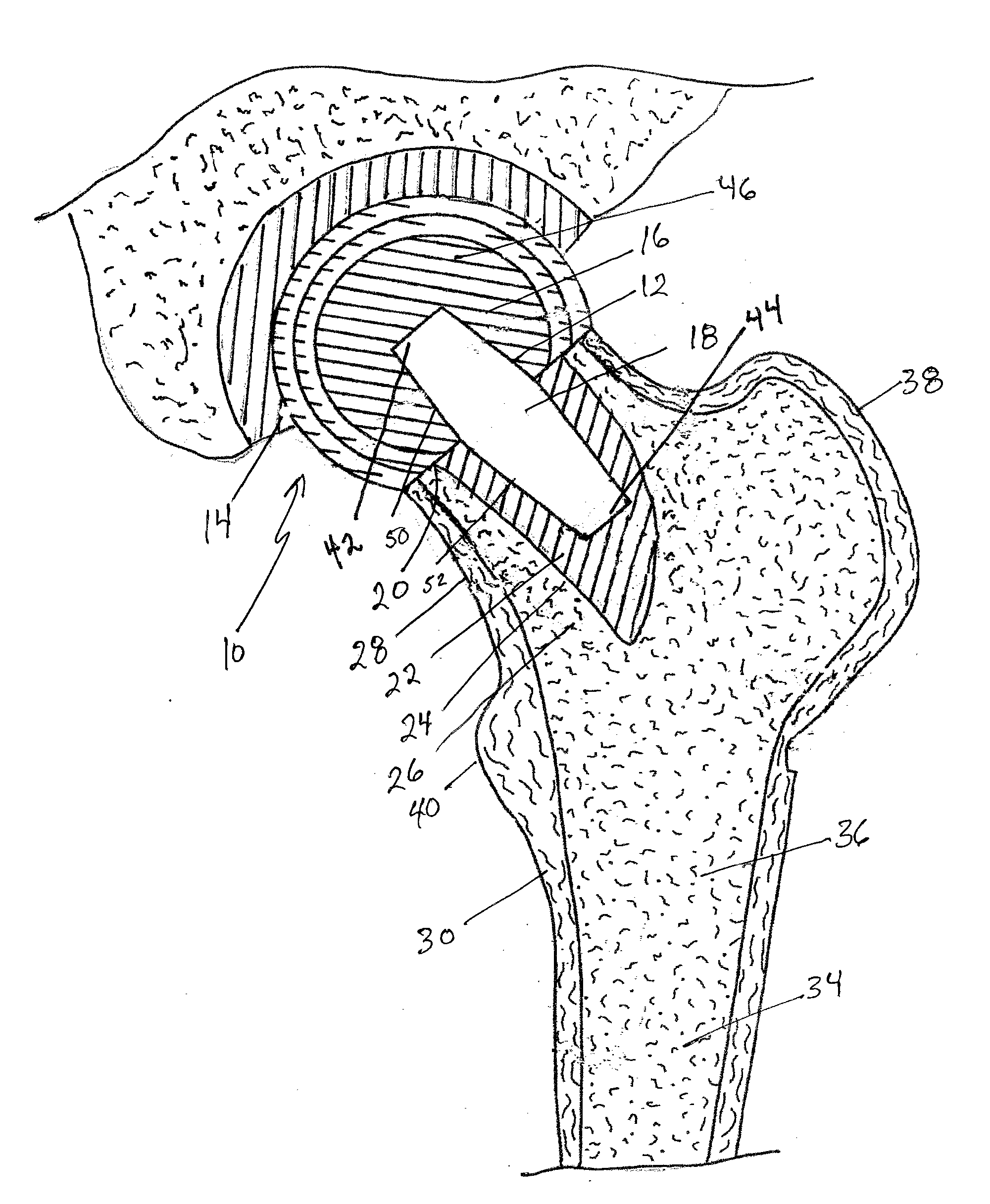 Femoral head calcar loading prosthesis