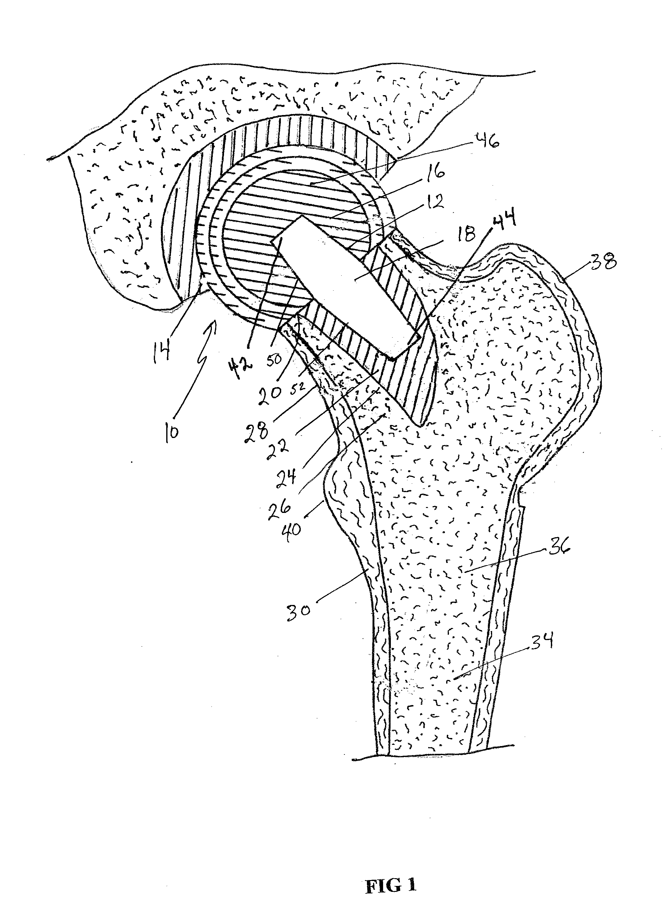 Femoral head calcar loading prosthesis