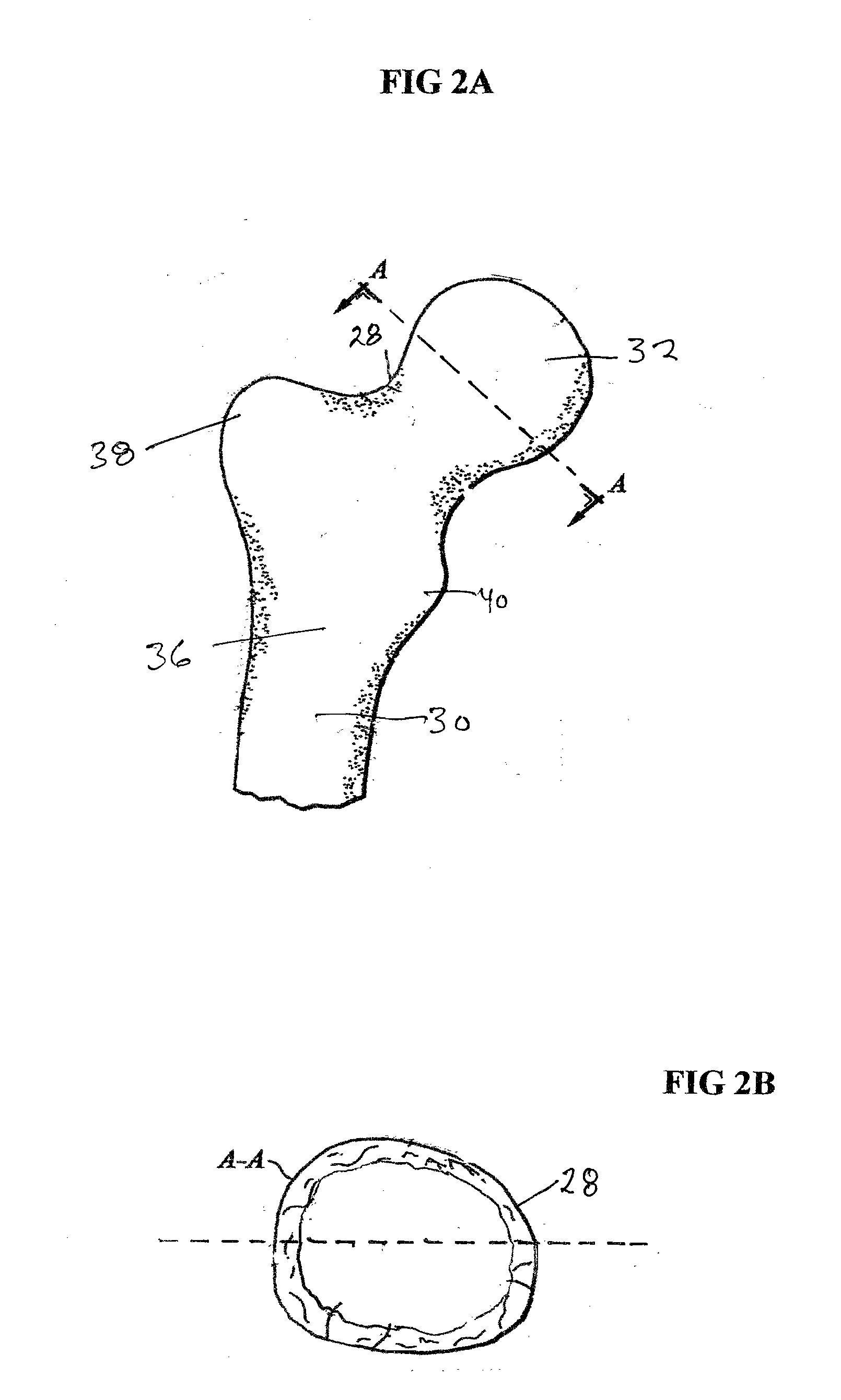 Femoral head calcar loading prosthesis