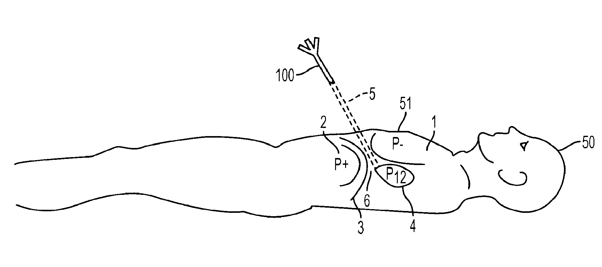 Access Needle Pressure Sensor Device and Method of Use