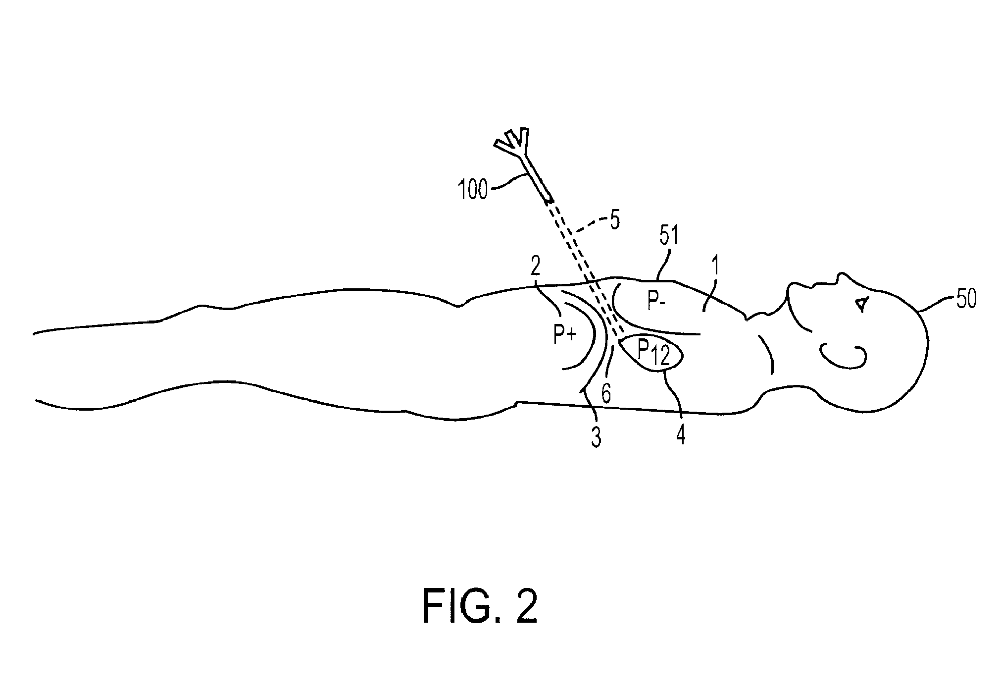 Access Needle Pressure Sensor Device and Method of Use