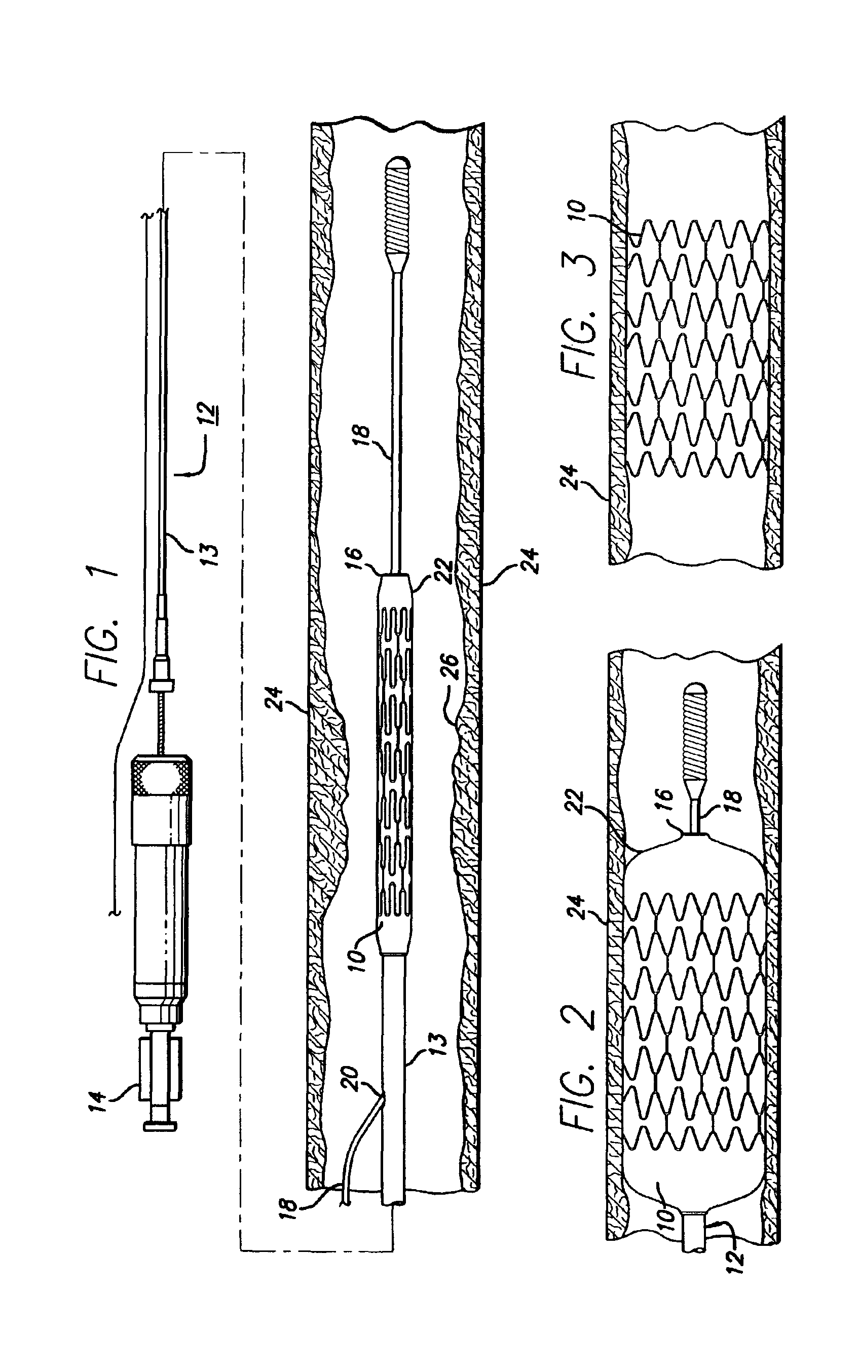 Apparatus and process for electrolytic removal of material from a medical device