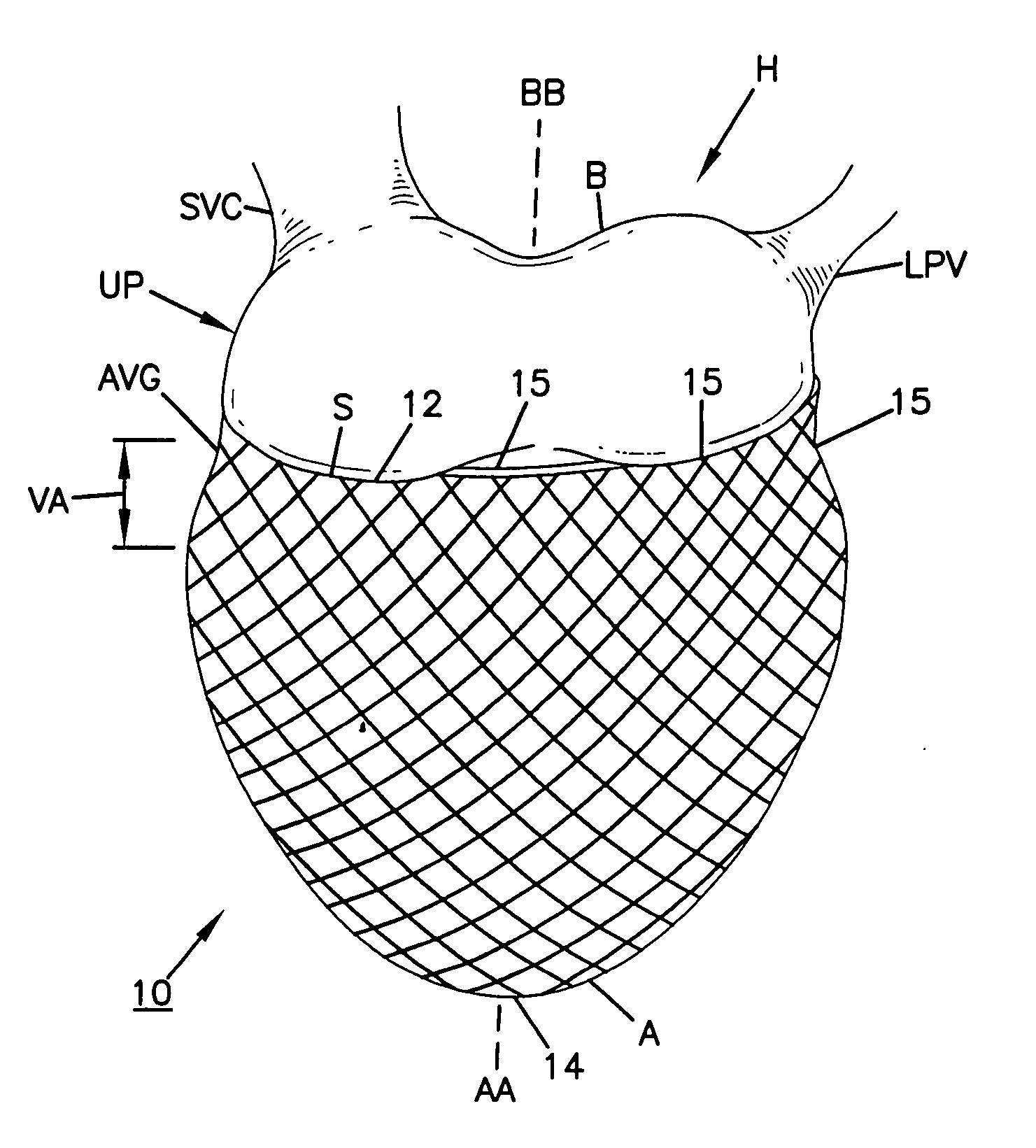 Cardiac support device