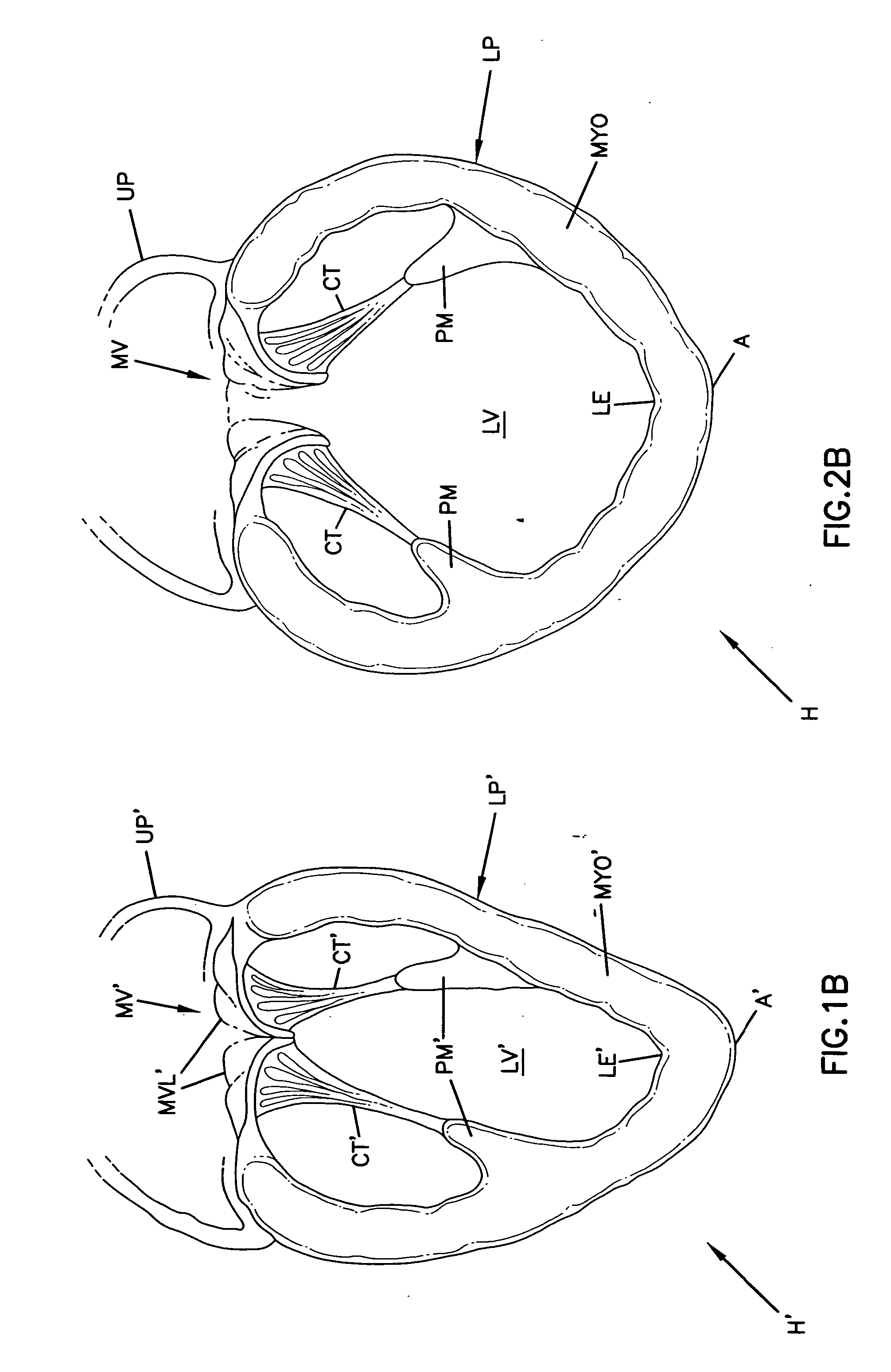 Cardiac support device