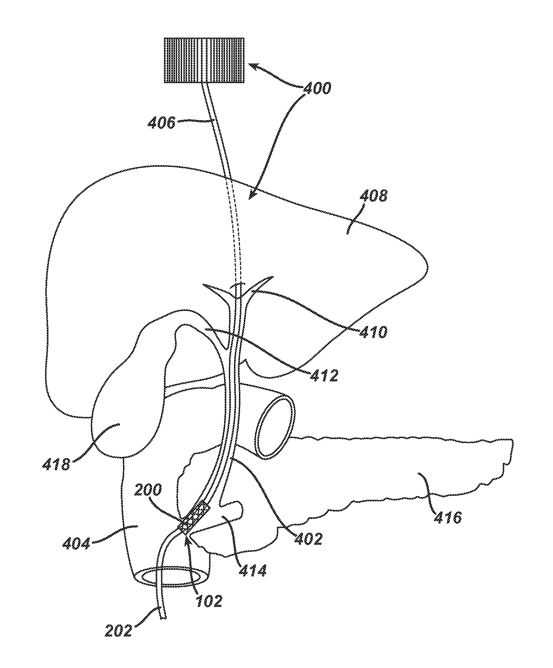 Catheter For Deactivating At Least A Portion of the Digestive Enzymes In An Amount Of Bile