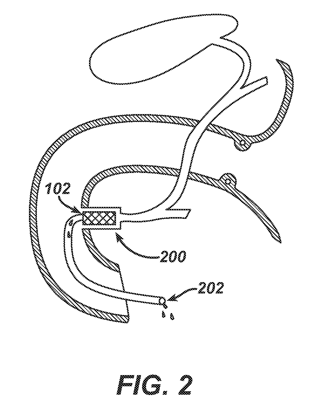 Catheter For Deactivating At Least A Portion of the Digestive Enzymes In An Amount Of Bile