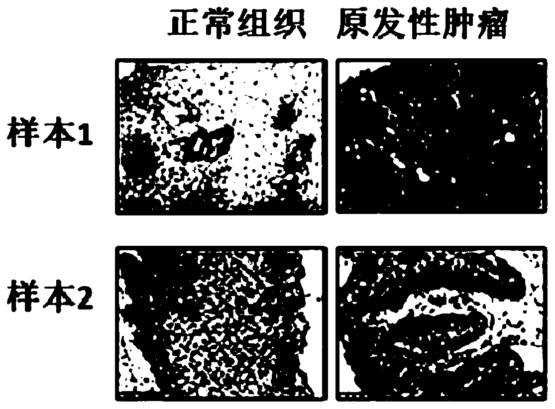 A biomarker for esophageal cancer and its application