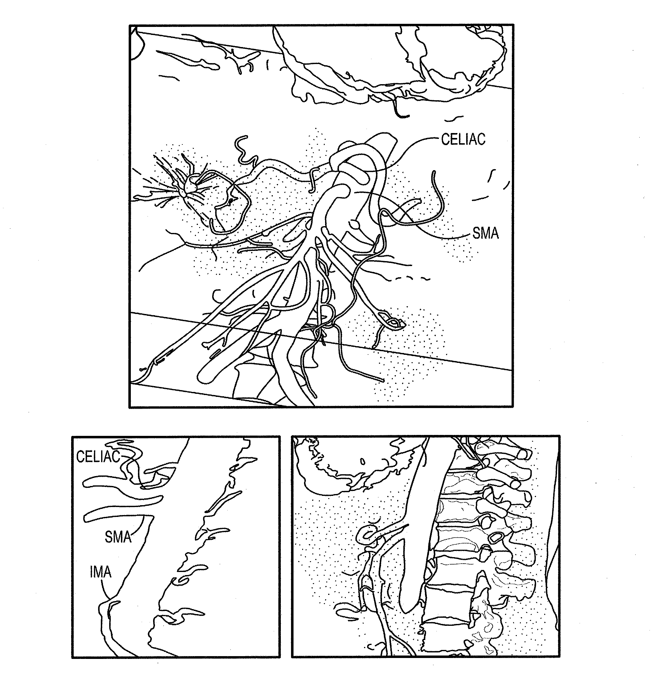 System and method of pre-aortic ganglion ablation