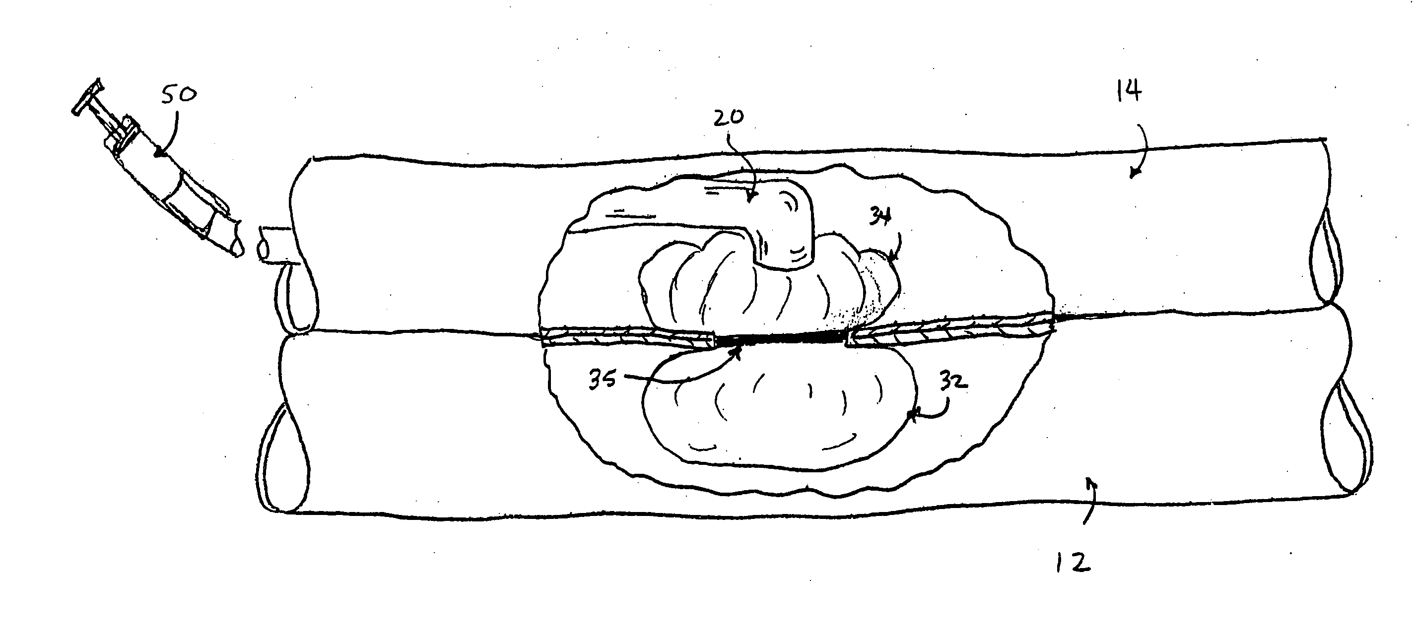 Anastomosis device and method