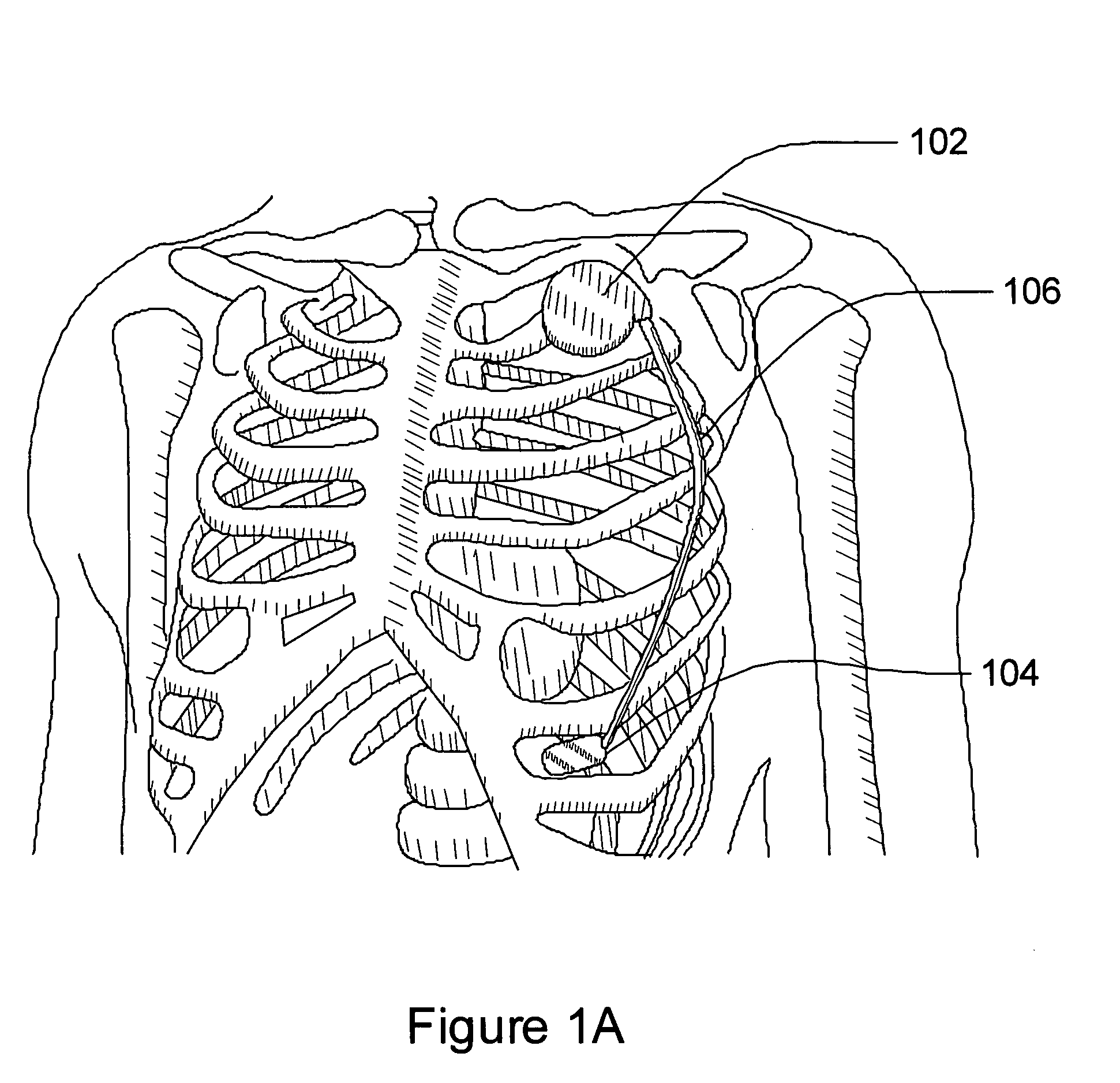 Multi-parameter arrhythmia discrimination