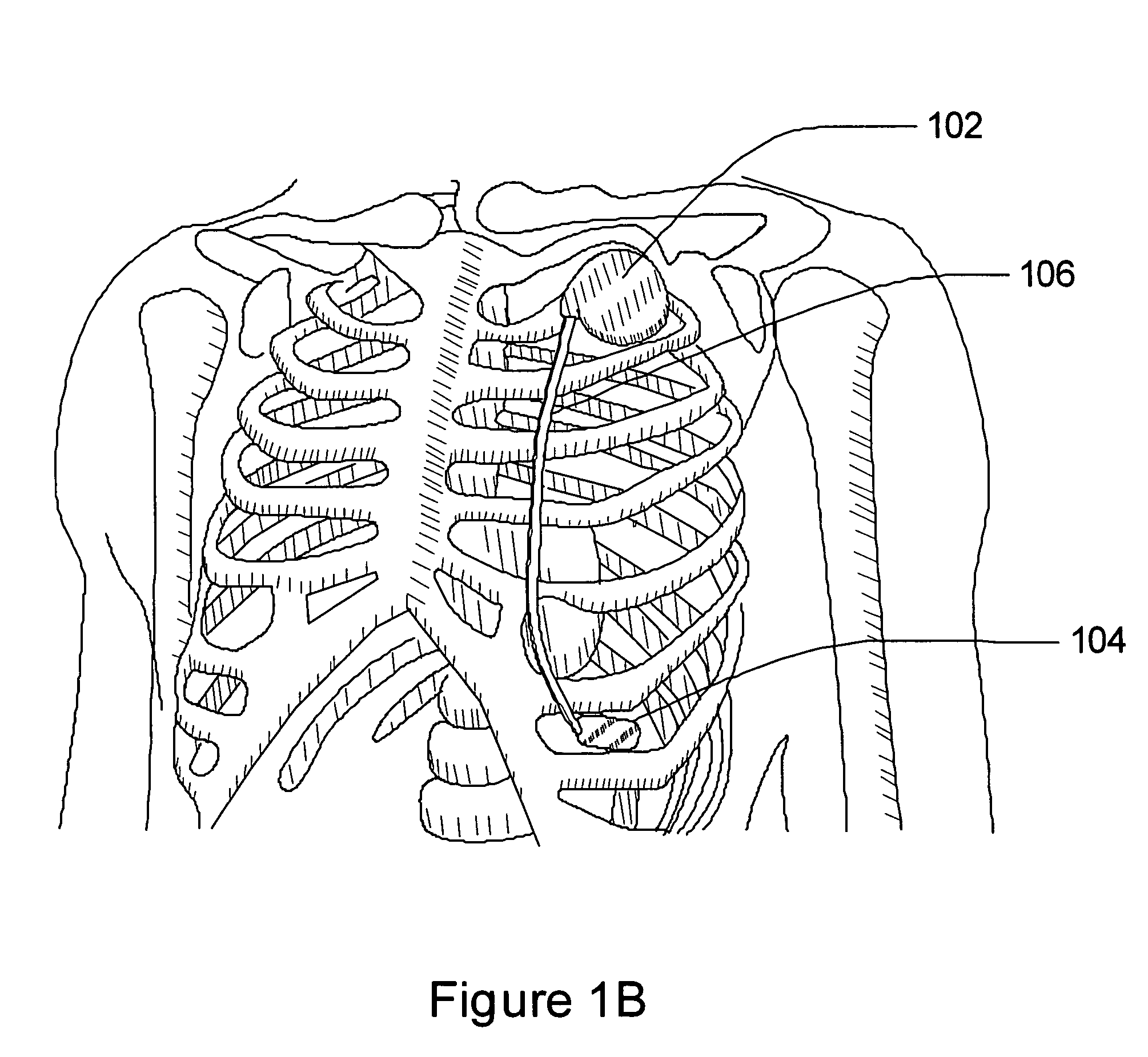 Multi-parameter arrhythmia discrimination