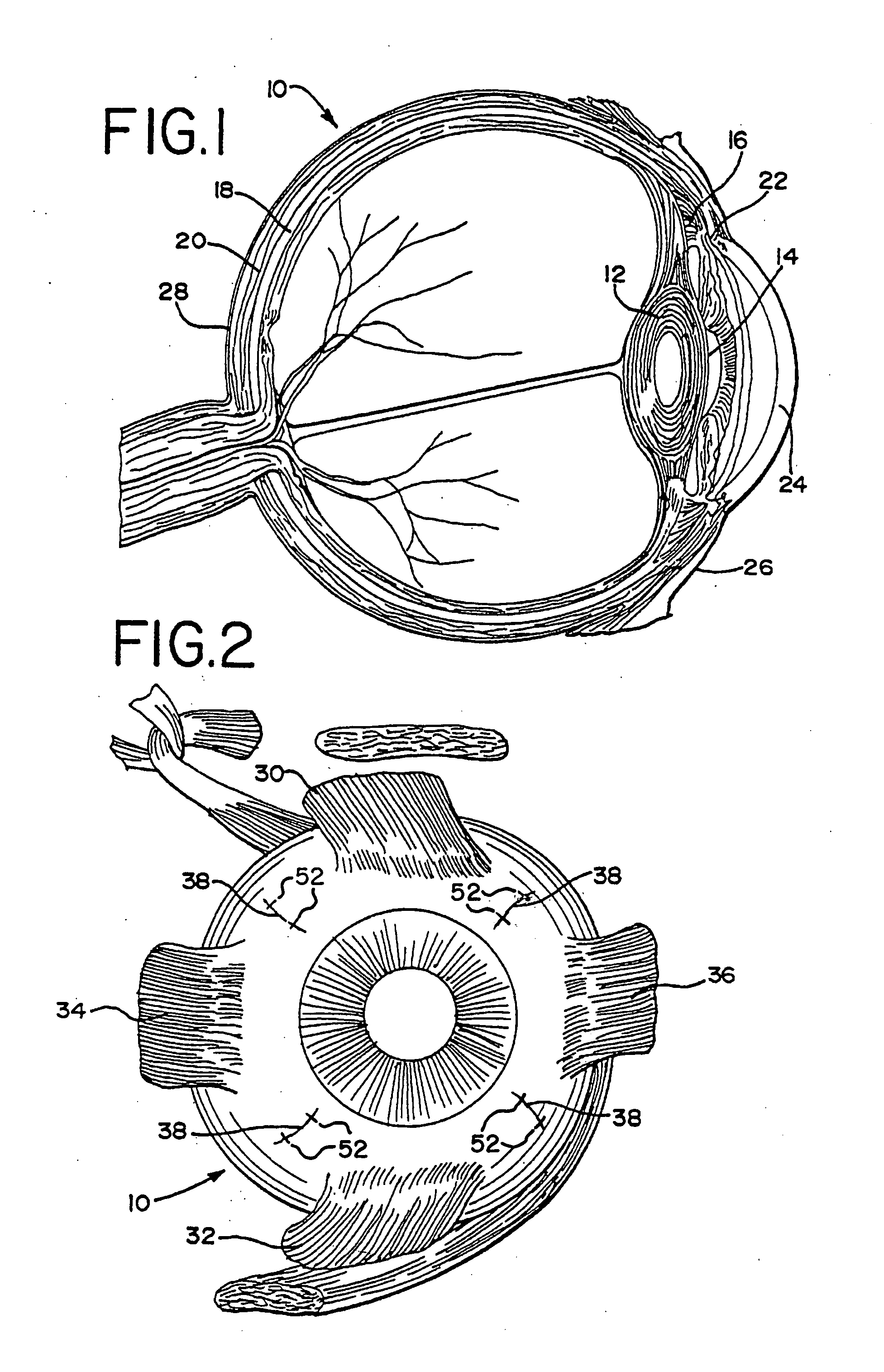 Ophthalmic clip and associated surgical method