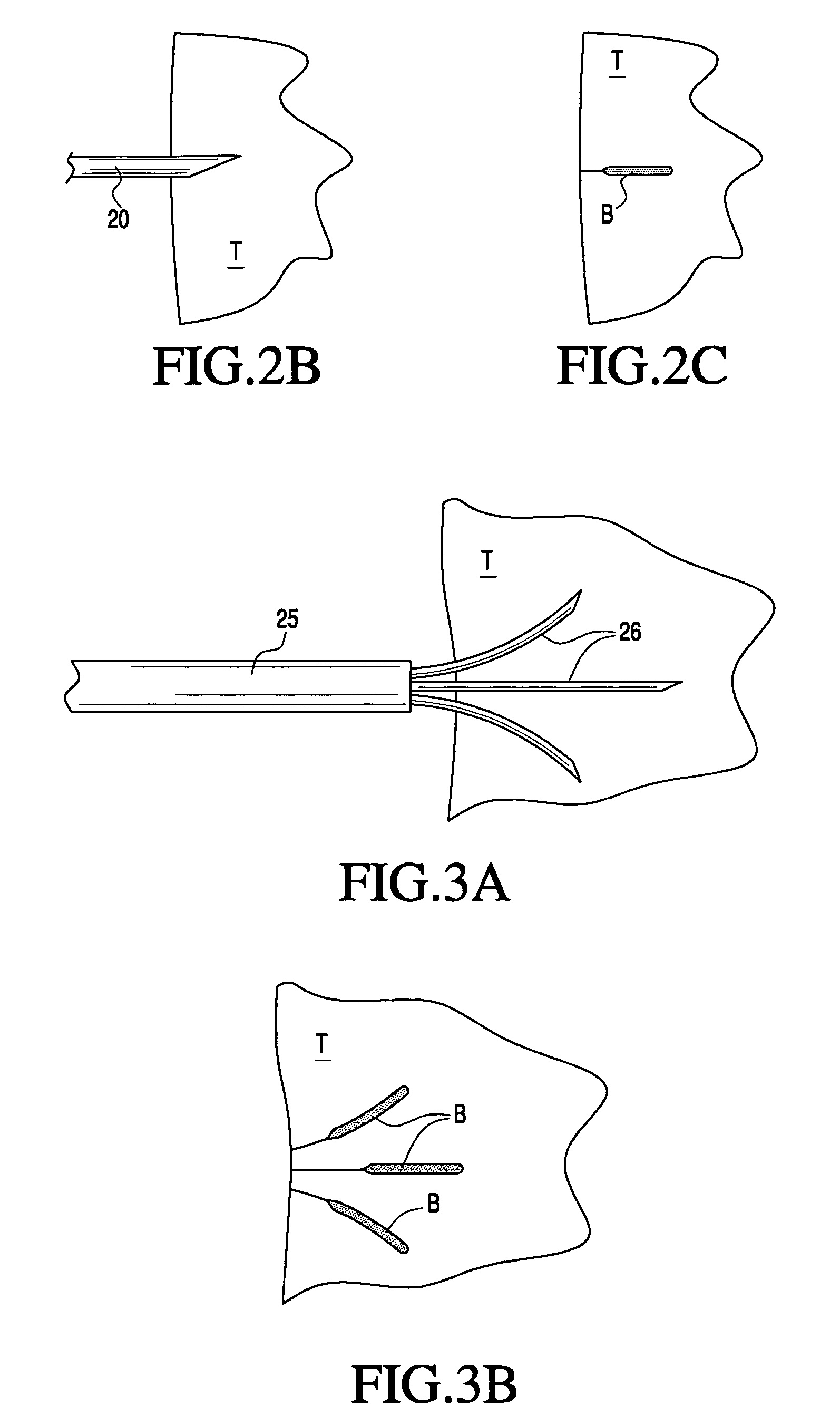 Apparatus and methods for treating tissue using passive injection systems