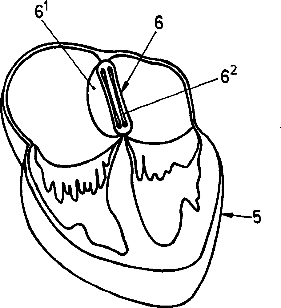 A device for plugging an opening such as in a wall of a hollow or tubular organ