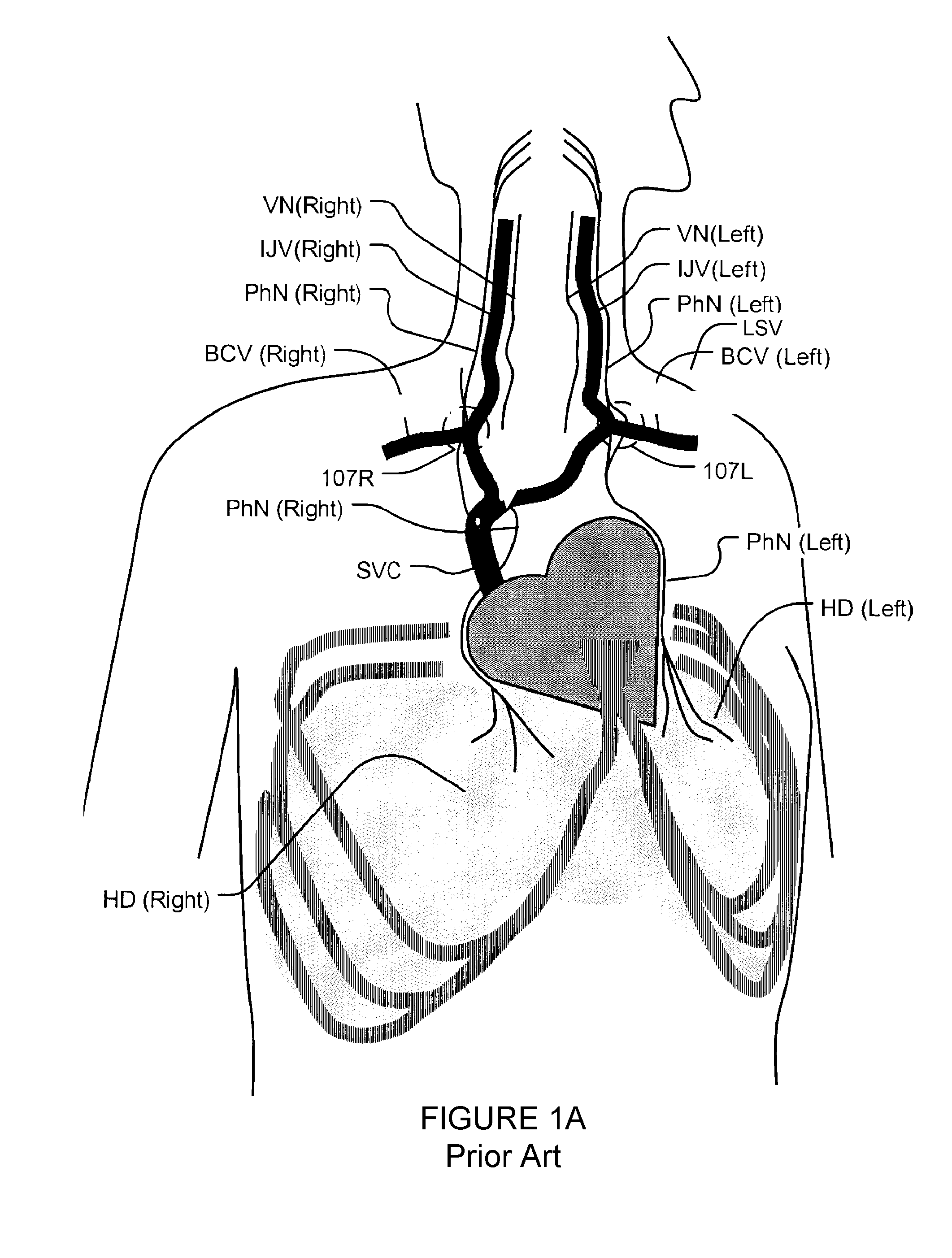 Transvascular nerve stimulation apparatus and methods