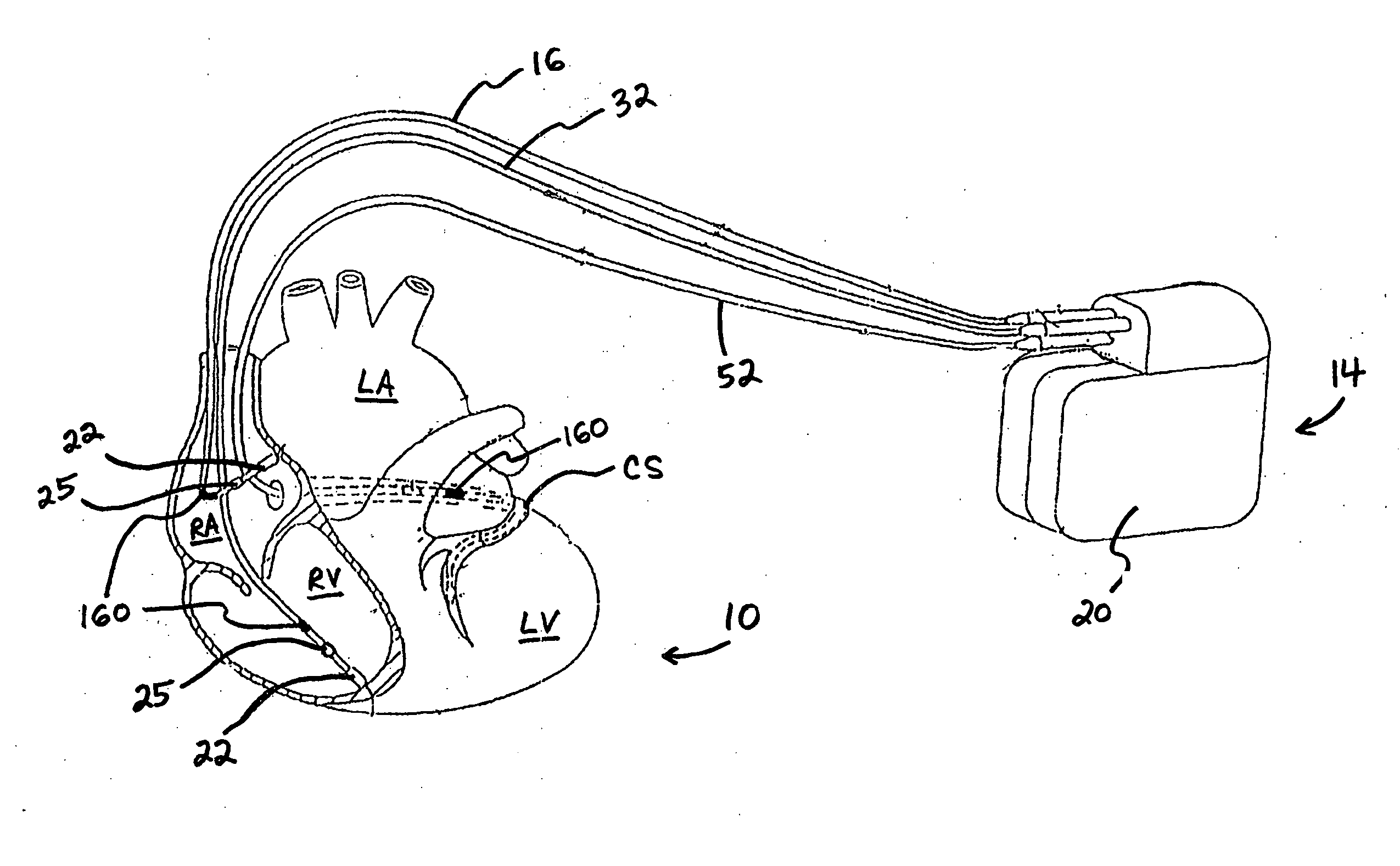 Method and system for controlling pulmonary capillary pressure