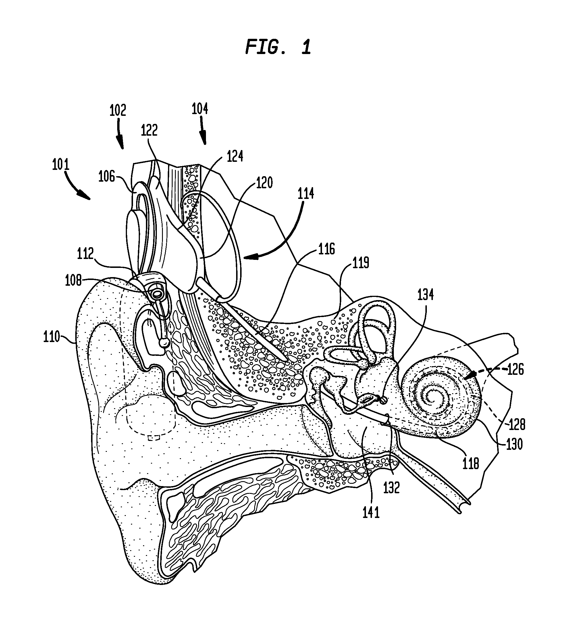 Event Detection In An Implantable Auditory Prosthesis