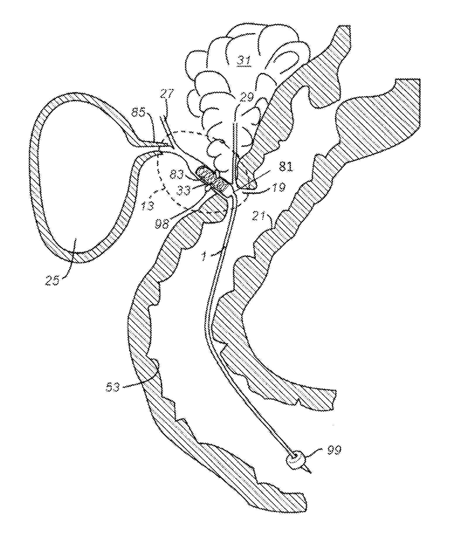 Methods and Apparatus for Treating Obesity and Diabetes