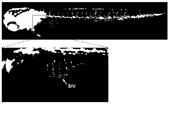 Application of chloroxine in preparing anti-angiogenesis medicine