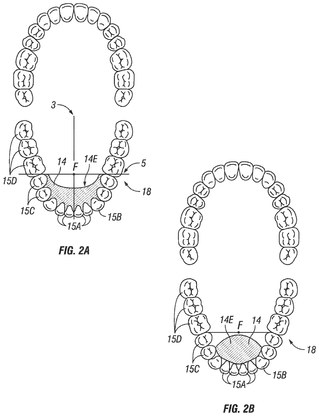 Lingual positioning device for sleep, breathing, jaw and airway disorders