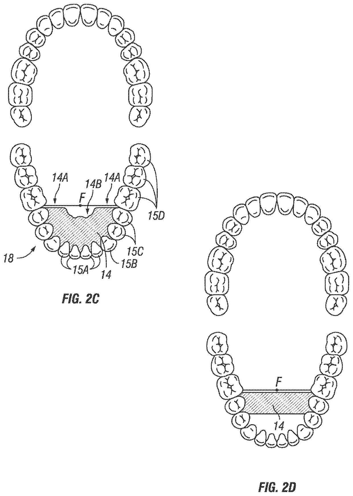 Lingual positioning device for sleep, breathing, jaw and airway disorders